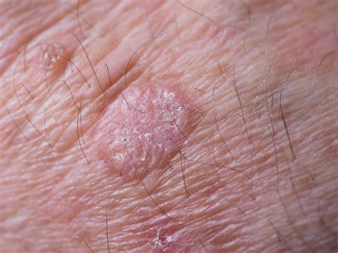 Should Actinic Keratosis Be Removed? – Balmonds