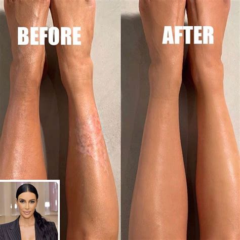 Kim Kardashian Covers Up Her Psoriasis Using New KKW Beauty Body Makeup