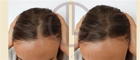 HAIR GROWTH LASER – The Luxe Clinic