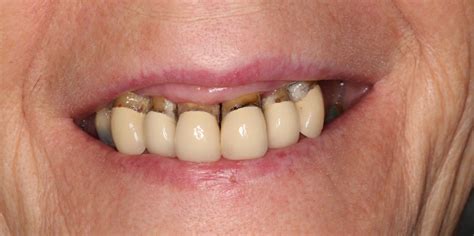 Before and After Dentures | The Vallance Dental Centre