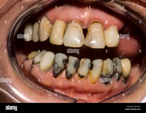 ORAL HEALTH with decaying teeth Stock Photo - Alamy