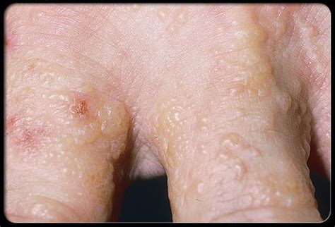 Dyshidrotic eczema (dyshidrotic dermatitis) is an irritation of the skin on the palms of the ...
