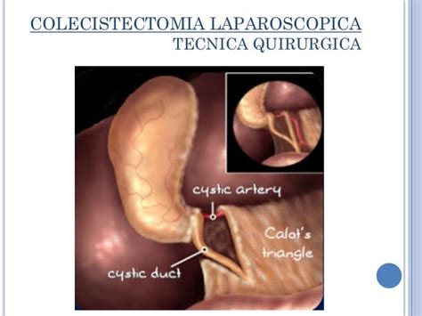 Colecistectomia laparoscopica