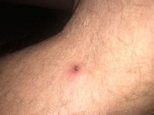 Help! I found a tick on me! – Think IPM Blog