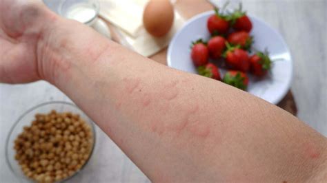 What Do Food Allergy Symptoms Look Like? | Chacko Allergy