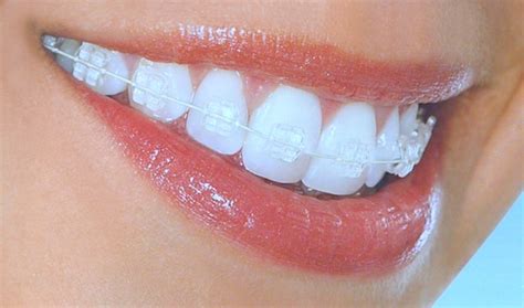 Ceramic Braces In Bangalore | Tooth Colored Braces In India