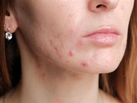 How to treat pimples on face | Variety