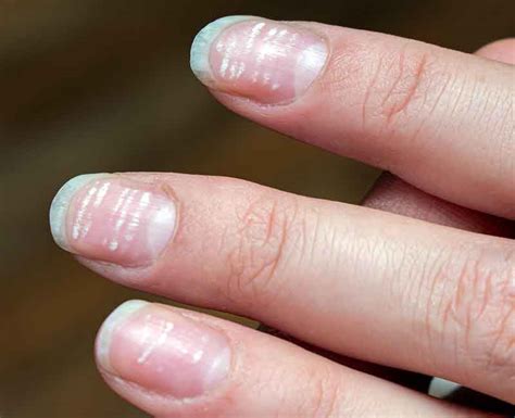 White Spots on Nails (Leukonychia): Causes & Treatment