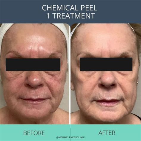 Day by Day Chemical Peel Recovery - The Ultimate Guide