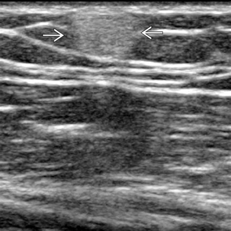 Lipoma | Radiology Key