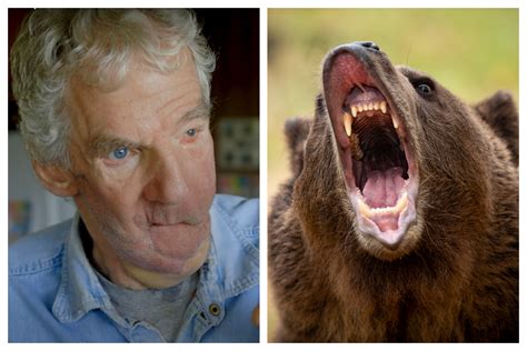 Man Who Had Face Torn Off by a Bear Had To Dig Debris From His Own Airway - Newsweek