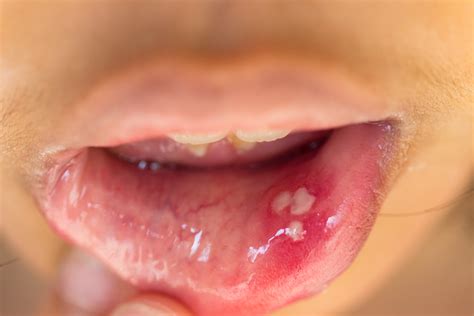 7 WAYS TO GET RID OF CANKER SORES - Health GadgetsNG