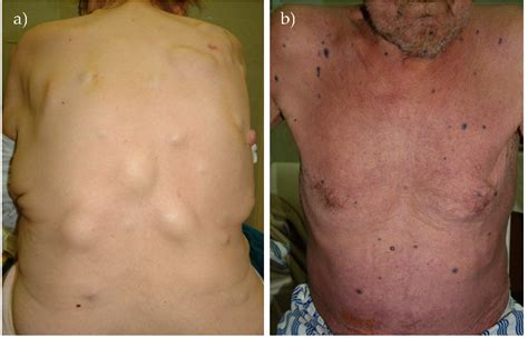 Surgery and Staging of Melanoma | IntechOpen