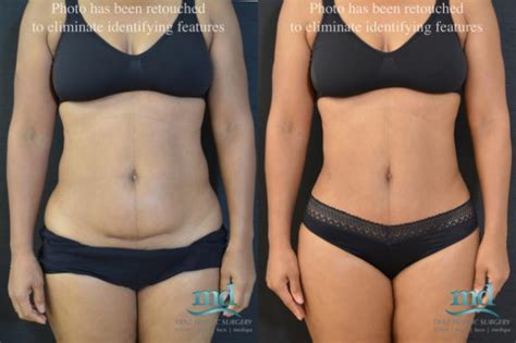 Mini Tummy Tuck Before and After Photos Case 19 | Melbourne, Viera, Brevard County, FL | Michael ...