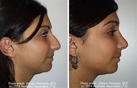 Ethnic Rhinoplasty Surgery in Portland Oregon