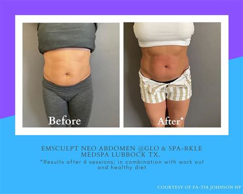 Emsculpt Neo Before & After Patient 02 | Glo & Sparkle