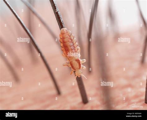 Head louse, illustration Stock Photo - Alamy