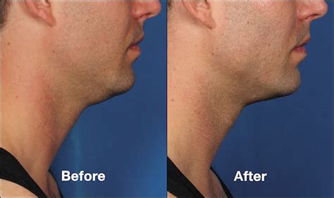 Kybella for Men | Reduce a Double Chin & Refine Your Jawline | Kalos ...