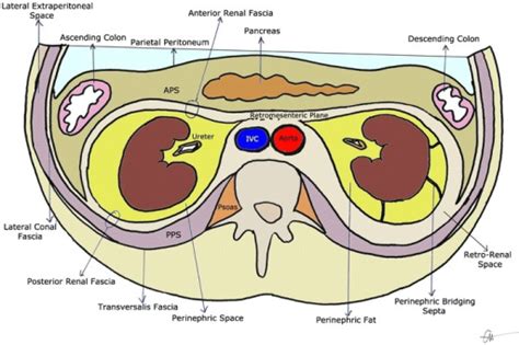 Perinephric abscess - WikEM