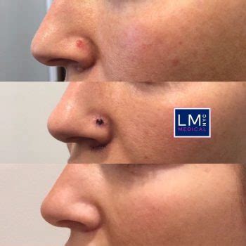 Skin Cancer / Mole Removal | LM Medical NYC