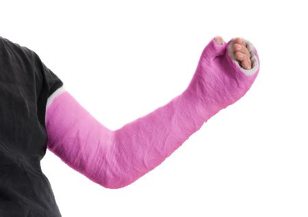 Broken Wrist Cast - Medical Experts