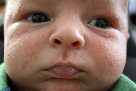 baby acne causes | BABY ACNE