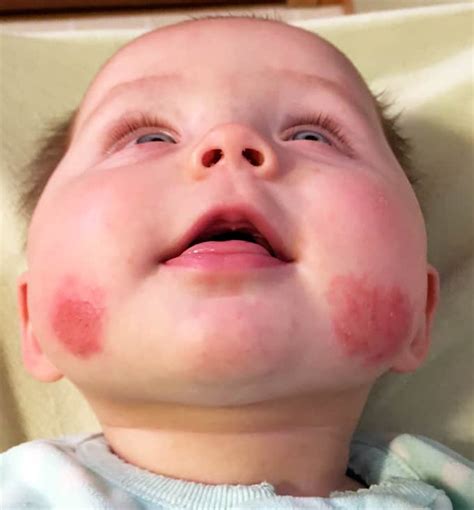 celiac disease rash in babies - Deandre Bolt