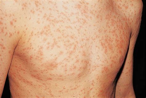 Skin Rash, Causes, Baby Skin Rash - Allergy, Fungal & Treatment