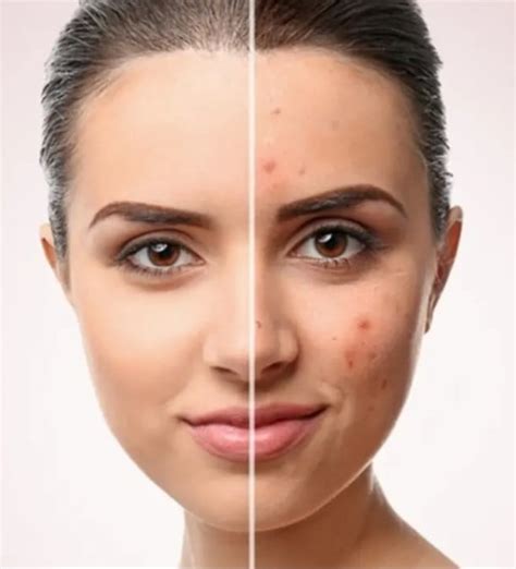 Accutane: Usage And Side Effects