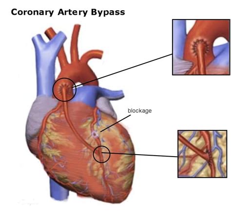 Healthier You | Coronary Artery Bypass Surgery(CABG)