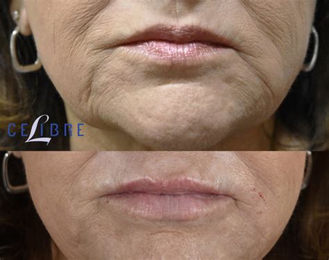 Juvederm Cheeks Before And After Photos