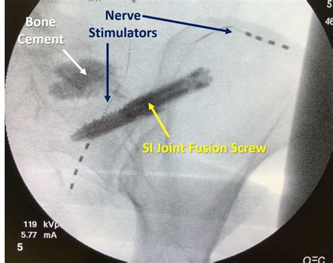 SI Joint Fusion Complications? Why Are We Doing this to Patients ...