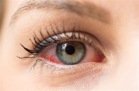 10 Causes & Treatments for Eye Redness | Niagara Falls, ON