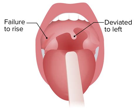 Cranial Nerve Palsies | Concise Medical Knowledge