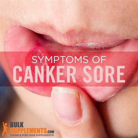 Canker Sores: Symptoms, Causes and Treatment