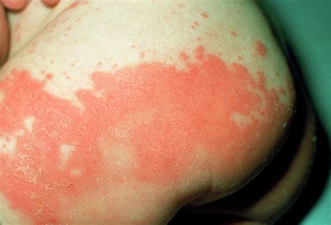 Candidiasis Nappy Rash | ubicaciondepersonas.cdmx.gob.mx