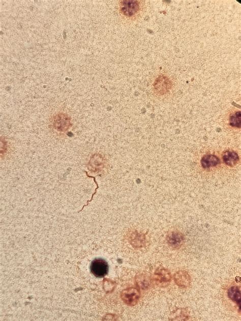 Gram Stain of of Synovial Fluid. Spirochete? Spirillum? Artifact? : r/ClinicalMicrobiology