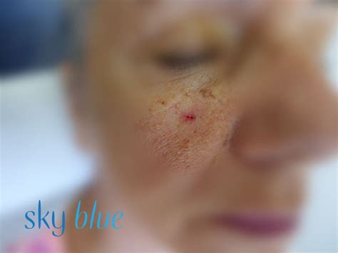 Nodular BCC 1 - Sky Blue Dermatology