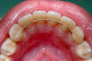 Braces Experience : r/Perempuan