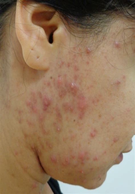 ACD A-Z of Skin - Adult Acne