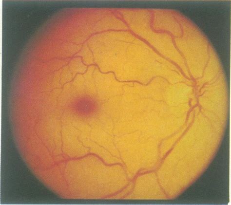 Central retinal artery occlusion with opacification of the retina and a... | Download Scientific ...