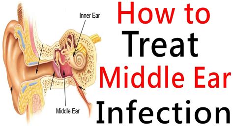 Middle Ear Infection & Middle Ear Effusion - Causes & Treatment