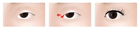 Epicanthoplasty: Guide to Eye Enlargement Surgery | Wave