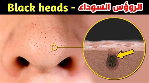 ما الذي يسبب الرؤوس السوداء على بشرتنا؟ الأسباب والعلاج _ ?What Causes Blackheads on Our Skin ...