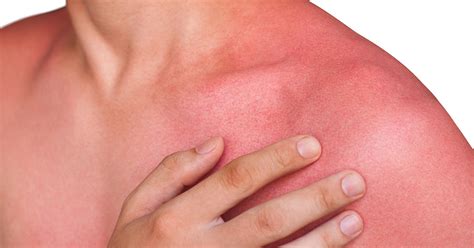 what does a heat rash look like pictures 11 natural ways to get rid of ...