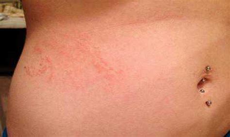 Scabies Rash On Stomach