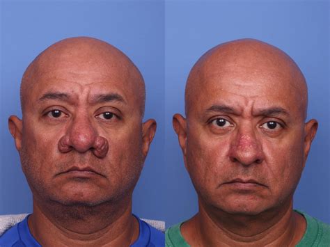 Rhinophyma Dermabrasion for Scottsdale & Phoenix, AZ | Dr. Todd Hobgood