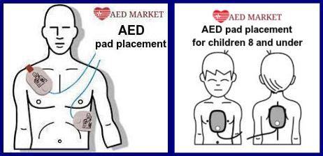 Proper AED Pad Placement | AED Market