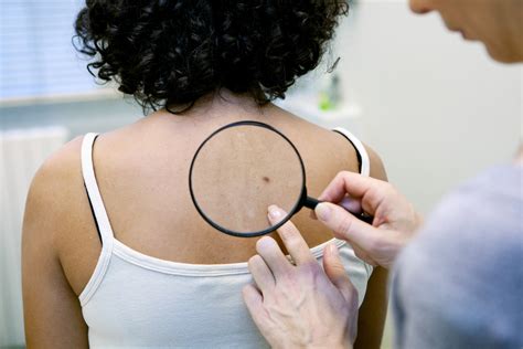 Skin Cancer Symptoms That are More Than Skin Deep – ActiveBeat – Your Daily Dose of Health Headlines