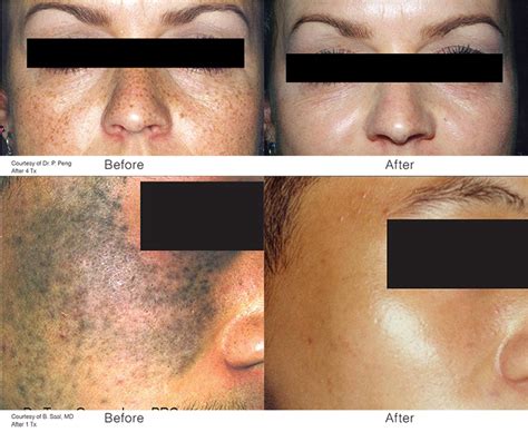 Revlite Laser | Melasma, Dark Underarms, Tattoo Removal,Skin Lightening